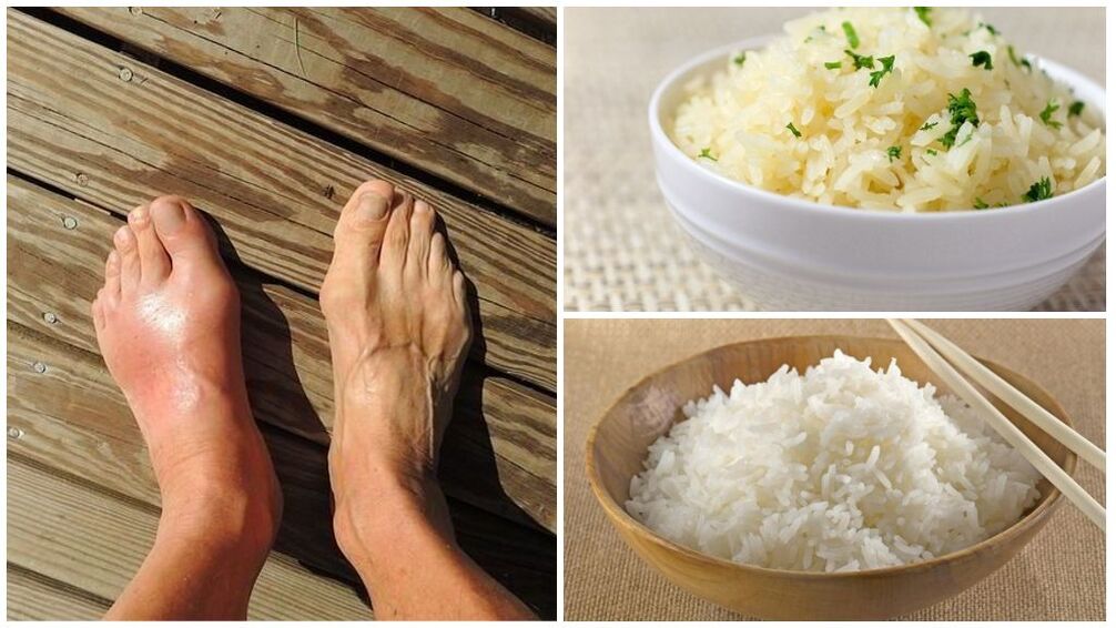 A rice-based diet is recommended for gout sufferers. 